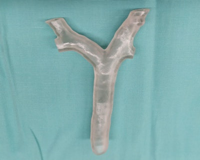3D-printed model of 7.5-year old patient's airway. All images courtesy of Dr. Ruth Shaylor.