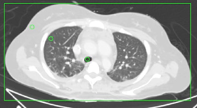 Image examples of regions of interest used for the quantitative evaluation in the thorax at the height of the tracheal bifurcation (above), the upper abdomen at the height of the portal vein (below, left), and the lower abdomen at the level of the lumbar spine L4 (below, right). A rectangle was used for measurements of the lateral and anterior-posterior diameter of the torso. Images courtesy of European Radiology.