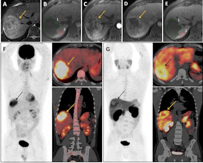 MR and dual-tracer PET/CT imaging in a 41-year-old man with poorly differentiated 90-mm HCC lesion in the right liver lobe (region of interest 1). HCC lesion appeared (A) slightly hyperintense on T2-weighted fat-suppressed images, (B) hypointense on T1-weighted precontrast volumetric interpolated breath-hold examination (VIBE) images, (C) hypervascular with heterogeneous arterial enhancement, (D) washout on portal-venous phase, and (E) markedly hypointense on HBP VIBE image compared with adjacent liver parenchyma (region of interest 2), with an LLCER value of -10.28%. F: F-18 FDG PET/CT showed a strong uptake in the lesion, while (G) F-18 FCH PET/ CT showed a peripheral increased activity and a central decreased activity compared with the liver background. Images courtesy of European Radiology.