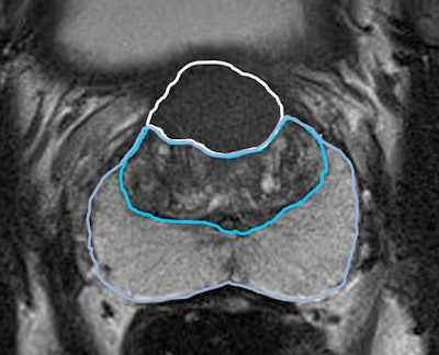 T2-weighted image shows the prostate of a patient (age unknown) with an elevated prostate-specific antigen (PSA) level and previous negative transrectal ultrasound guided biopsies. Multiparametric MRI showed a large PI-RADS 5 lesion in the anterior part of the transition zone, which proved to be a clinically significant prostate cancer (International Society of Urologic Pathologists [ISUP] grade 3). Benign prostatic hypertrophy in the transition is visible as 'organized chaos' (blue area). All images courtesy of Prof. Jelle Barentsz, Dr. Maarten de Rooij, and Dr. Bas Israël.