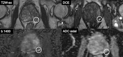 Multiparametric MRI of 74-year-old patient with a PSA of 9.6. Transperineal MR-guided biopsy showed an ISUP grade 4 cancer (Gleason score 4 + 4 = 8). The case highlights the benefit of using dynamic contrast-enhanced MRI (DCE). The small lesion in the left peripheral zone shows vivid focal enhancement on DCE. Such small lesions can easily be missed without DCE. The patient had a successful radical prostatectomy.