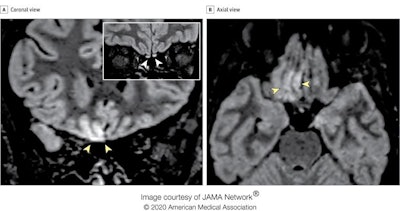 Brain MRI alterations in radiographer with COVID-19 who presenting with anosmia four days from symptom onset. Coronal (A) and axial (B) reformatted 3D fluid-attenuated inversion recovery (FLAIR) images show cortical hyperintensity in the right gyrus rectus (yellow arrowheads in A and B). In the inset in A, a coronal 2D FLAIR image shows subtle hyperintensity in the bilateral olfactory bulbs (white arrowheads). The cortical hyperintensity is present only in the posterior portion of the right gyrus rectus (B). Accordingly, the cortical hyperintensity of the right gyrus rectus is evident in the more posterior coronal image (A) and not in the anterior coronal one (inset). All images courtesy of JAMA Network.