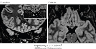 Follow-up MRI in the same patient 28 days from symptom onset. Coronal (A) and axial (B) reformatted 3D FLAIR images show complete resolution of the previously seen signal alteration within the cortex of the right gyrus rectus. In the inset, a coronal 2D FLAIR image shows a slight reduction of the hyperintensity and the thickness of the olfactory bulbs, suggesting a postinfection olfactory loss.