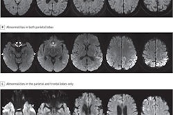 A: A man in his 70s with sCJD subtype VV2 with signal hyperintensity in the body of the left caudate, without evidence of signal abnormality in the putamina and neocortical ribbon. B: A woman in her 60s with sCJD subtype MM1 with signal hyperintensity in the cortical ribbon of both parietal lobes, left greater than right, and left precuneus without evidence of abnormality in the striatum, thalami, and cortical ribbon of the temporal and occipital lobes. C: A woman in her 70s with sCJD subtype MM1 with signal hyperintensity in the precuneus (right greater than left) and right parietal cortex. Images courtesy of JAMA Neurology.