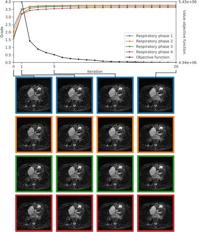 Above and below are two examples of automated image quality assessment by IQ-DCNN during iterative compressed sensing reconstruction. The quality of the whole-heart image volumes corresponding to the four reconstructed respiratory phases is assessed at each iteration on the standard image quality scale of 0 (poor quality) to 4 (excellent). Phase 1 represents the most end-expiratory phase, while phase 4 refers to end-inspiration. All images courtesy of Radiology: Artificial Intelligence.