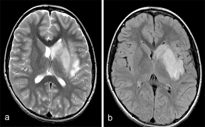 MRI demonstrated findings consistent with acute infarction without microhemorrhages (a, b, and c), along with focal irregular narrowing and banding of the proximal M1 segment of the left middle cerebral artery with a slightly reduced distal flow (d), according to Mirzaee and colleagues. Images courtesy of the RSNA.