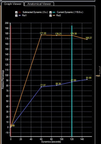 Time-intensity curves of the uterus (orange) and solid tissue of the mass (blue) demonstrate type 2 curve with typical initial rise followed by a plateau. At histopathology, in this area, foci of invasive cancer were seen. Images courtesy of European Radiology.