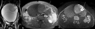 Mucinous borderline tumor and stage IA invasive ovarian cancer in a 28-year-old woman. Coronal T2 (a) demonstrates a large multilocular cystic mass of the right ovary typical of a mucinous tumor. At its superior aspect areas with irregular septations, contrast enhancement (b), and restricted diffusion (c) are demonstrated (arrow).