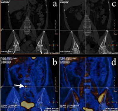 PET/CT images from a 53-year-old woman with breast cancer in the course of therapy but with rising biomarkers. (a, b) PET/CT images midtherapy. (c, d) Basal PET/CT images. Bone M1 can only be seen with FDG-PET. Images courtesy of Dr. José Vercher-Conejero.