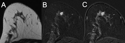 MRI of a 47-year-old high-risk patient (A, T2-weighted; B and C, subtracted early and late contrast-enhanced, T1-weighted images) shows a rather circumscribed mass lesion with heterogeneous internal enhancement and washout, corresponding to a Kaiser score of 8. Histology revealed a luminal-type invasive lobular cancer, B5b. Images courtesy of European Radiology.