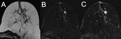 MRI of a 39-year-old high-risk patient (A, T2-weighted; B and C, subtracted early and late contrast-enhanced, T1-weighted images) shows a circumscribed mass lesion with heterogeneous internal enhancement and persistent signal increase, corresponding to a Kaiser score of 1. Note the fibroadenoma-like T2-weighted correlate (A). Histopathology revealed a fibroadenoma, B2.