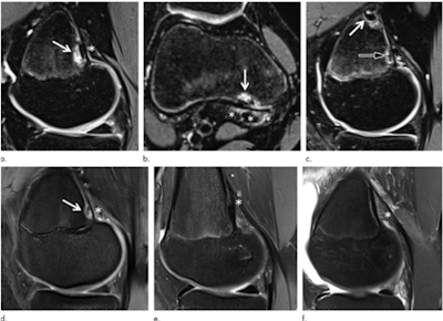 Images show examples of (a-d) DFCI at the tendon attachment of the medial head of the gastrocnemius muscle [MHG] and (e, f) knees without DFCI. Sagittal (a) and axial (b) fat-suppressed T2-weighted MRI scans in a 14-year-old female competitive skier show a 5-mm DFCI (arrow) at the distal MHG attachment (*). (c) Sagittal fat-suppressed T2-weighted MRI scan in another 14-year-old female competitive skier shows simultaneous DFCIs at the proximal (8 mm; white arrow) and distal (4 mm; black arrow) part of the MHG tendon attachment (*). (d) Sagittal fat-suppressed proton density-weighted MRI scan in a 14-year-old female control participant shows a 4-mm DFCI (arrow) at the distal MHG attachment (*). Sagittal fat-suppressed proton density-weighted MRI scans in 15-year-old female control participant (e) and 15-year-old male control participant (f) without a DFCI for comparison. The broad and fan-shaped appearance of the proximal MHG tendon (*) is especially well visualized in (f) because of edematous demarcation after knee trauma. Caption and images courtesy of the RSNA.