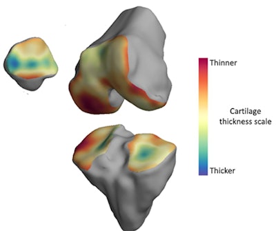 The thickness of the cartilage covering the end of each bone is color-coded, with red areas denoting thinner cartilage and green-blue areas denoting thicker cartilage. The technique helps locate where arthritis is affecting the joint over time. Image courtesy of the University of Cambridge.