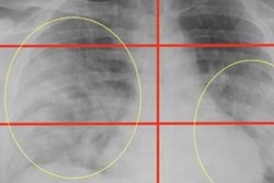 2020 06 19 15 26 9347 2020 05 14 Toussie Chest Xray 20200619152947