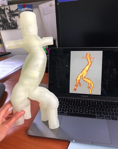 The first 3D-printed aortic model produced at the Marie Lannelongue hospital.