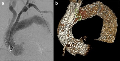 Haulon's team is working on new endografts for endovascular Bentall procedures. All images courtesy of Prof. Stéphan Haulon, PhD.