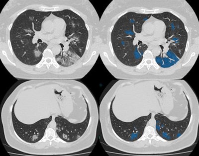 The AI solution is capable of learning from the database containing the CT scans with marked-up annotated lung lesions, aggregated by the Moscow Center for Diagnostics and Telemedicine.