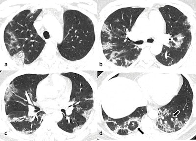 Noncontrast axial chest CT images in lung window settings of a 40-year-old male patient who tested positive for COVID-19, obtained eight days after symptom onset, in craniocaudal sequence (a,b,c,d) showing multiple patchy peripheral predominantly posterior ground-glass opacities with progression to consolidation in both lungs. There is also evidence of atoll sign in the right lung (black arrow in d) and perilesional vessel enlargement in the left lung (black arrow with white border in d). All images courtesy of Dr. Abdul Haseeb Wani, Dr. Arshed Hussain Parry, and the European Journal of Radiology.