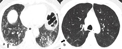 Noncontrast chest CT axial image (a) in a 62-year-old male patient who tested positive for COVID-19, obtained nine days after symptom onset, showing subpleural curvilinear lines (black arrow) with multiple reticulations in the right lower lobe and mixed ground-glass opacities and consolidation pattern in the left lower lobe. Noncontrast chest CT axial image (b) in a different 61-year-old male patient who was COVID-19 positive, obtained six days after symptom onset, shows evidence of subpleural reticulations (black arrow) in the posterior segment of the right upper lobe with a few rounded morphology ground-glass opacities in the left upper lobe.