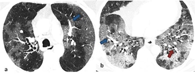 Noncontrast axial chest CT images in lung window settings of a 62-year-old male patient who tested positive for COVID-19, obtained five days after symptom onset, showing diffuse ground-glass opacities in peripheral and central distribution progressing to frank consolidation. There is also evidence of intralesional vessel enlargement (blue arrows in a & b) and bronchial dilatation (red arrow in b).