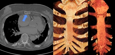 Fracture of the sternum. The fracture cannot be detected on either CR or VR because of the missing dislocation. Left to right: CT image, CR image, VR image.