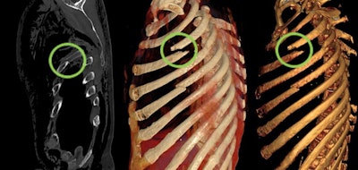 Rib fractures with substantial dislocation of the third rib (green circles). Left to right: CT given a Likert score of 2 (good expressiveness, good visualization of the finding), CR given a Likert score of 1 (high expressiveness, very good visualization of the finding), VR with a Likert score of 2 (good expressiveness). All images courtesy of Judith Böven and the BJR.