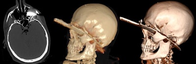 Remaining knife. Left to right: CT image with a Likert score of 3 (medium expressiveness, finding can be detected), CR with a Likert score of 1 (high expressiveness, very good visualization of the finding), VR with a Likert score of 2 (good expressiveness).