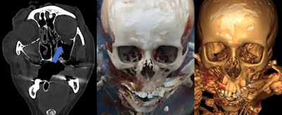 Blowout fracture of left orbita (blue arrow). Left to right: CT reconstruction with a Likert score of 1 (high expressiveness, very good visualization of the finding), CR with a Likert score of 4 (lower expressiveness, finding can hardly be detected), VR with a Likert score of 5 (very low expressiveness, finding cannot be detected).