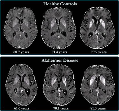 R2* maps of healthy control participants and participants with Alzheimer disease. R2* maps are windowed between 10 and 50 sec-1. Images courtesy of the RSNA.