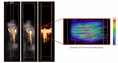 Left: 3D power-Doppler volumes overlaid on anatomical volumes of the myocardium in the left-anterior descending artery. Right: Absolute flow velocities estimated by 4D ultrafast ultrasound flow imaging. All images courtesy of Physics in Medicine and Biology.