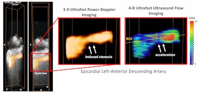 Power-Doppler volumes overlaid on anatomical B-mode volumes show the induced stenosis. 4D ultrafast ultrasound flow imaging (right panel) shows the induced flow acceleration at the centre of the stenosis.