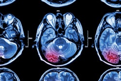 2020 07 10 22 42 7022 Stroke Mri 400