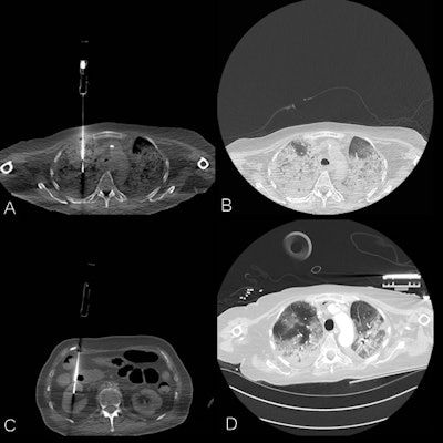 A series of annotated CT images of COVID-19 patients. A: Postmortem lung biopsy, same region as premortem CT image. B: Postmortem lung window, same region as premortem CT image. C: Postmortem renal biopsy. D: Premortem CT, 24 hours before biopsies. Courtesy of Dr. Jan Vanrusselt.