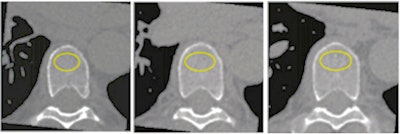 A participant's noncontrast-enhanced axial CT with volume of interest (yellow circles) in the trabecular bone compartment of three vertebrae for bone mineral density measurements. Images and caption courtesy of the RSNA.