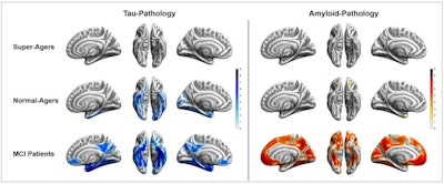 Tau (blue) and amyloid (orange) distribution patterns for super-agers, normal-agers, and MCI patients, who were compared to a group of younger, healthy, cognitively normal, amyloid-negative individuals. Brain projections are depicted at an uncorrected significance (p < 0.0001). Color bars represent the respective t-statistic. Images courtesy of SNMMI and Hoenig et al.
