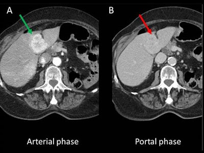A dedicated CT protocol for typically hypervascular tumors should include the arterial phase. A: Hepatic metastasis of renal cell carcinoma hypervascular in the arterial phase. B: In the portal phase, it is almost isodense with the rest of the parenchyma and becomes much less conspicuous. All figures courtesy of Dr. Ainhoa Viteri Jusué, presented at ECR 2020.