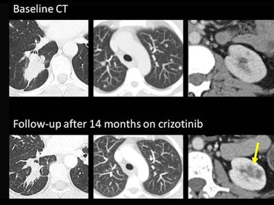 Crizotinib-induced complex renal cysts can be mistaken for malignant lesions. Top row: Baseline CT scan of a woman with stage IV ALK-mutated lung adenocarcinoma (right lower lobe mass and bilateral lung metastases) and tiny uncomplicated cortical renal cysts. Lower row: Follow-up, 14 months on crizotinib, partial response (decreased size of the right lower lobe mass and disappearance of pulmonary nodules). Development of complex cystic masses in both kidneys is consistent with crizotinib-induced renal cysts (arrow).