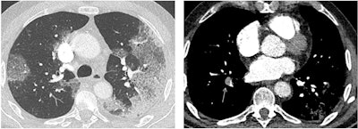 Right lower lobe pulmonary embolism (arrow) complicating COVID-19 pneumonia in a 78-year-old man with left predominance of COVID-19 pneumonia.