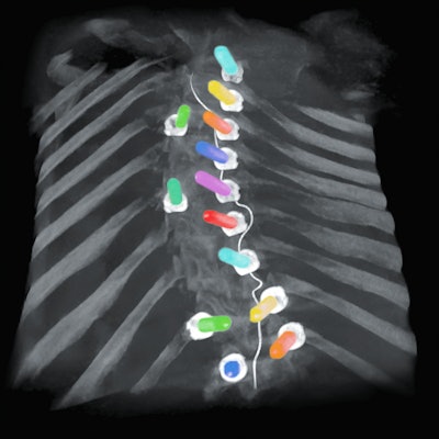 Ziehm has added colorization to enable better visualization of screws and vessels. Image courtesy of Ziehm.