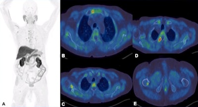 F-18 choline PET-CT examination. A: MIP images show increased tracer uptake in the mediastinum, right axilla and right femur in a patient with prostate cancer. B-E: There is focal increased tracer uptake with the sclerotic lesions in the sternum, right scapula, right transverse process of T3 vertebra, right femur on the fused transaxial PET-CT. Low grade tracer uptake within the mediastinal and hilar nodes are suggestive of reactive/inflammatory changes.