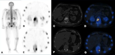 Technetium-99m MDP SPECT/CT examination. A: Whole-body image shows increased tracer uptake at T12 and L1 vertebrae in a patient with breast cancer. B-D: Increased tracer uptake in the sclerotic lesion in the L1 vertebra is in keeping with bone metastasis. E-G: Increased tracer uptake on the left side of T12 vertebra localizes to a facet joint (degenerative disease). All images courtesy of Dr. Oi Yean Wong and Dr. Gopinath Gnanasegaran.