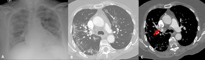 70-year-old patient with COVID-19 pneumonia with radiologic improvement but clinical deterioration. CT angiography was performed. (A and B) chest x-ray and lung window from CT angiography showing bilateral peripheral reticular and ground-glass opacities suggesting COVID-19 pneumonia in resolution stage. (C) CT angiogram showing a pulmonary embolism in right upper lobe artery (arrow).