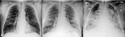 Portable chest x-rays from a 69-year-old male with COVID-19 pneumonia. (A) Admission chest x ray with subtle bilateral interstitial opacities. (B) Three days later, x-ray showing bilateral peripheral airspace opacities characteristics of COVID-19 pneumonia. (C) Chest x-ray one month after admission with diffuse alveolar opacities compatible with Diffuse alveolar damage/acute respiratory distress syndrome in a patient with fatal evolution. Images courtesy of Dr. Marcelo Sánchez.