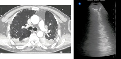 Crazy paving, consolidation, and ground glass on CT (left). Irregular pleural line, subpleural consolidation, and confluent B-lines on ultrasound (right).