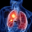 2020 07 22 19 19 3936 Lung Cancer Hotspot 400