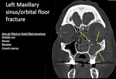 CT shows maxillary sinus fracture from blast and infilling of blood.