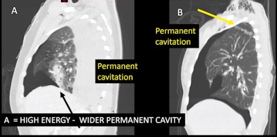 Patient A has high energy wound with wide cavity. In patient B, the cavity is narrower and the bullet is lodged posteriorly.