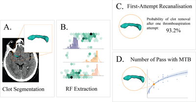 Method for predicting a mechanical thrombectomy strategy for successful reperfusion in the validation cohort. (A) Thrombi were manually segmented on noncontrast CT by a neuroradiologist while guided by the corresponding angio-CT image. (B) Radiomic features were then automatically extracted from the segmented thrombi in a training cohort and used to train two machine-learning models: (C) a first model that aimed to predict first-attempt recanalization with thromboaspiration, and (D) a second model aimed to predict the overall number of passages with mechanical thrombectomy devices for successful reperfusion. Images and caption courtesy of Dr. Jeremy Hofmeister.