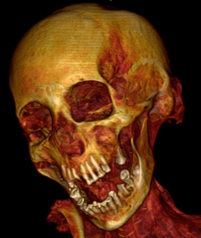 3D CT image shows extensive dental attrition and periodontitis.
