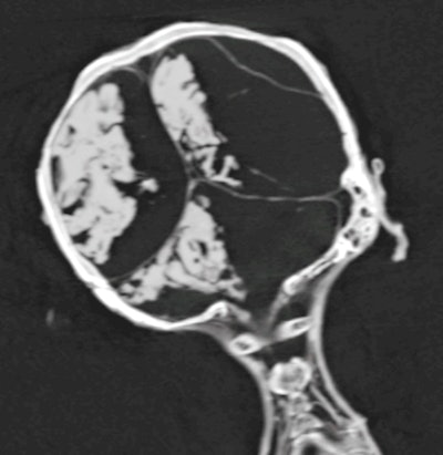 Coronal CT image of the head and neck of mummy shows the desiccated brain shifted to the right side of the cranial cavity.